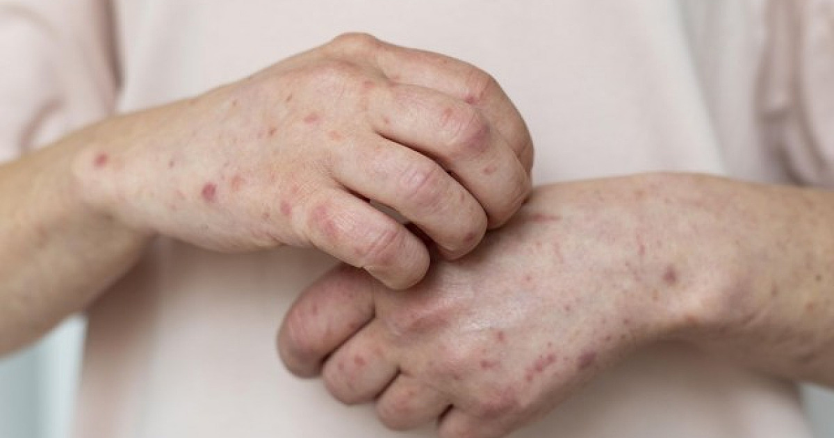Barueri chega a 13 casos de Monkeypox; Parnaíba segue com três