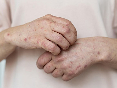 Barueri chega a 13 casos de Monkeypox; Parnaíba segue com três