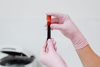 Exame de sangue para detectar Alzheimer chega ao Brasil e custa R$ 3 mil